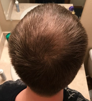 15% minoxidil Results With Before & After Pictures | Real Users