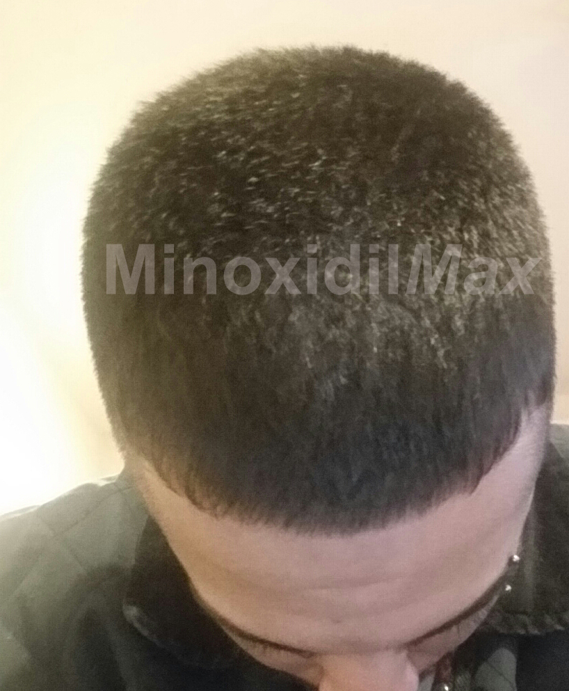 4 Months Rogaine (Frontal Areas) Awesome results | HairLossTalk Forums