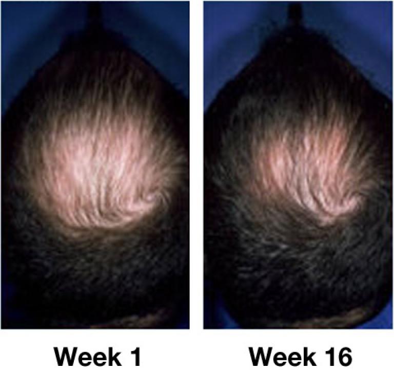 Rogaine® | Advanced Hair Restoration