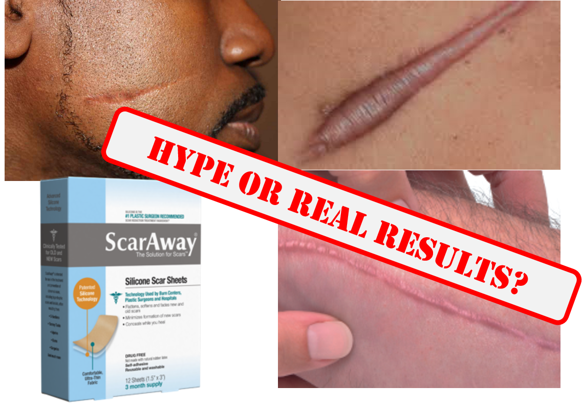 Is ScarAway the Best Scar Solution? ScarAway Review by Dermaflage