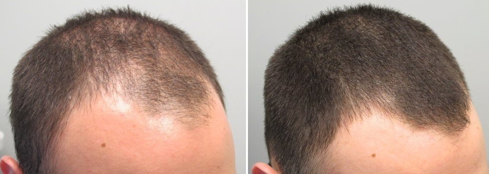 2.5 Months With Rogaine, Seeing Results! | HairLossTalk Forums