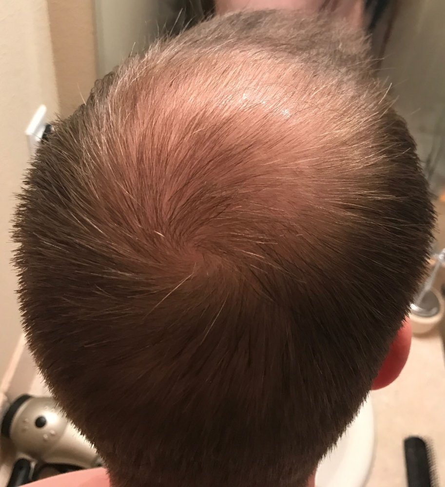 2.5 Months With Rogaine, Seeing Results! | HairLossTalk Forums