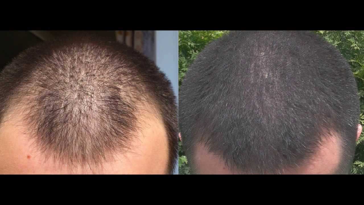 1 year minoxidil hair regrowth results, before and after. 2013 